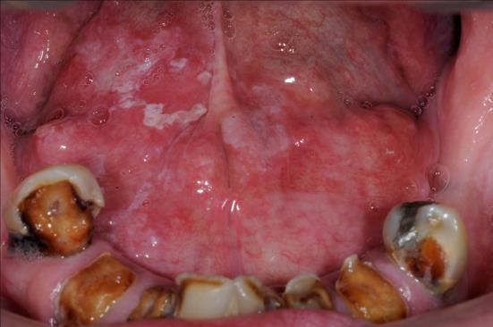 21 Early cancer floor of mouth Erythroleukoplakia. Floor of the mouth (high risk site).