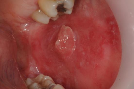 Cancer buccal Irregular swelling with surrounding erythroplakia. Painless or painful.