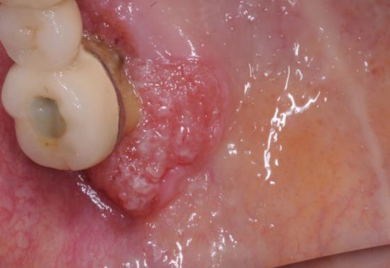 Cancer gingivae Gingival lesion with an irregular surface that includes red and white areas.