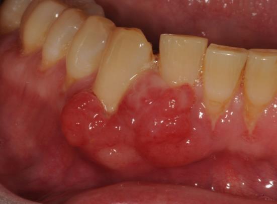 Cancer gingivae Irregular soft tissue swelling on the gingivae, but not restricted to the gingival