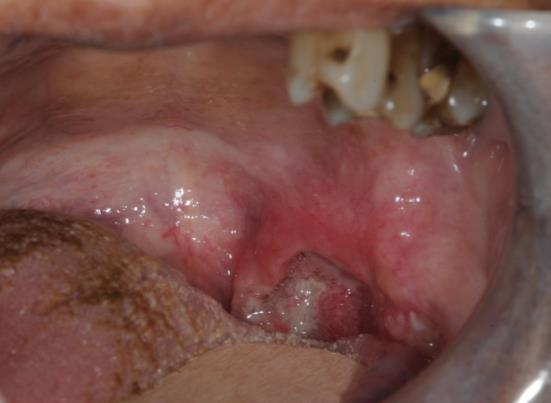 22 Cancer oropharynx Solitary ulcer visible, but only when the defensive tongue is physically depressed (a lesion easy to miss).
