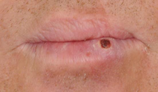 Palpate an indurated lump Palpate induration (firmness/hardness) evident on palpation of the ulcer.