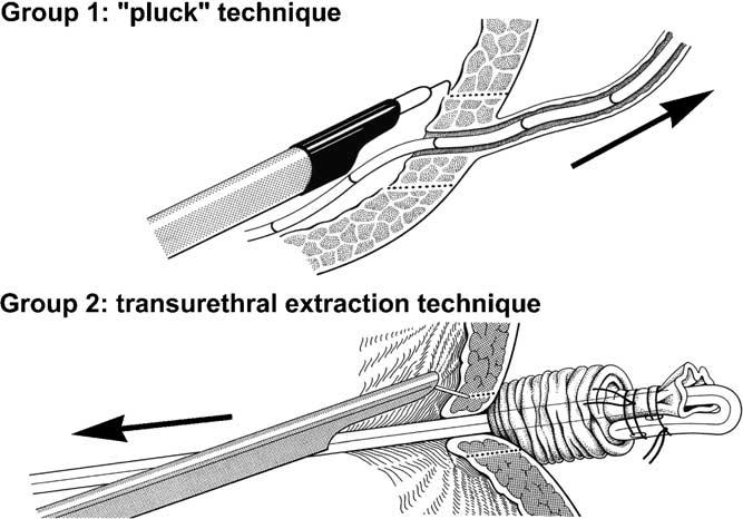 B. Ubrig et al. / European Urology 46 (2004) 741 747 743 Fig. 1. Pluck technique (Group 1): The intramural ureter is circumferentially excised.