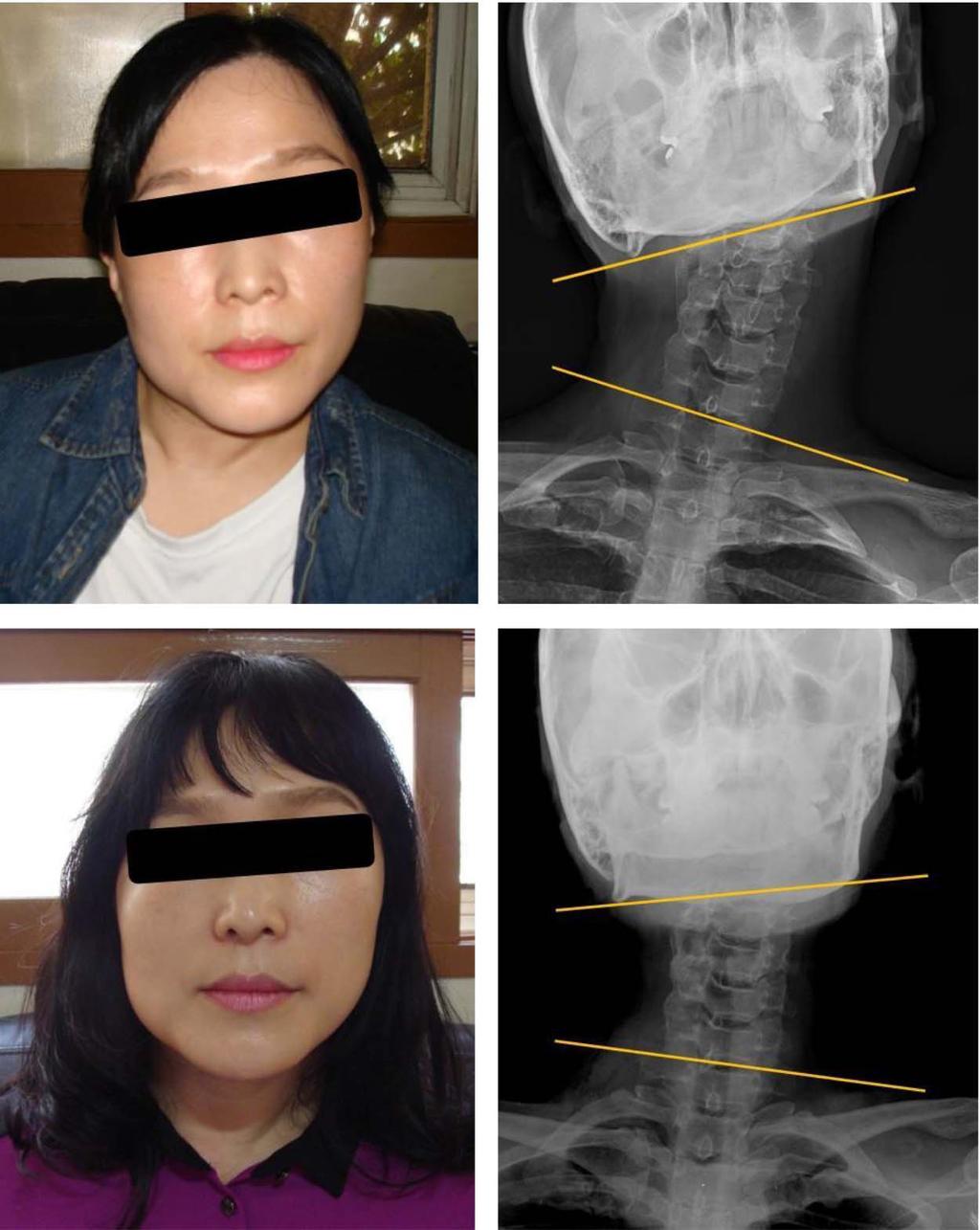 J Korean Neurosurg Soc 60 January 2017 patient's neck was extended with a sandbag, and then the patient's head was turned toward the shoulder on the opposite, uninvolved side.