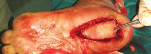 One patient showed venous congestion, which improved with loosening of sutures and multiple superficial incisions. One flap had superficial skin necrosis, which healed with dressings only.