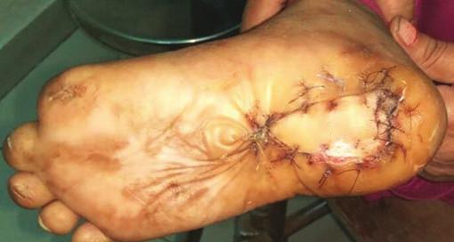 One medial plantar island flap was lost because of compression/kinking of pedicle in the postoperative period.