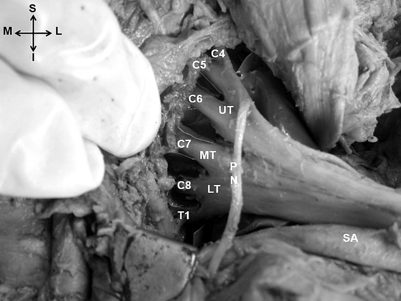224 Anat Cell Biol 2013;46:223-227 Uma Viswanathan, et al cord (Fig. 1), which was lateral to the subclavian artery in the supraclavicular region.