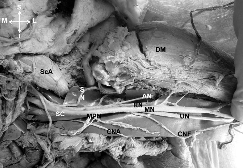 The long thoracic nerve arose from C5, C6, and C7 nerve roots, as in normal anatomy. All the branches that arose from the common cord were either supra- or retroclavicular in origin.