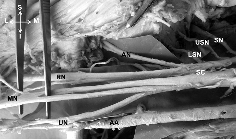 Bilateral single cord of the brachial plexus Anat Cell Biol 2013;46:223-227 225 left side, this cord was not seen in the axilla, where only the branches were observed.