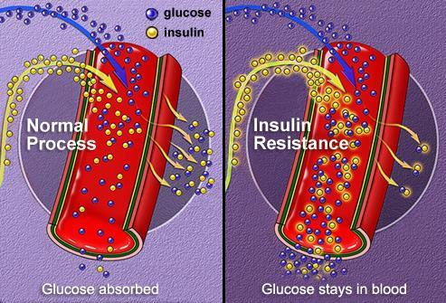 2. Glucose - Insulin Resistance Too much sugar insulin stops working as it should. The cells become resistant to it.