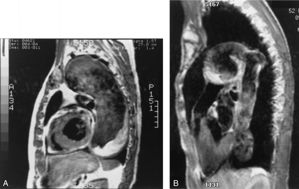 The Journal of Thoracic and Volume 115, Number 1 Westaby and Katsumata 165 Fig. 2. A, Chronic type B dissection in a patient with Marfan syndrome.