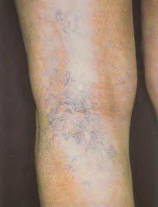 Reticular varicosis / spider veins Reticular varicosis is an intra cutaneous network