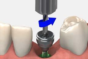 Laser-Lok has been shown to create a biologic seal by establishing a physical, connective tissue attachment to the abutment.