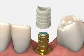 Note: Replace the healing abutment immediately to prevent soft tissue collapse over the implant. Remove the healing abutment. Verify the implant prosthetic platform is free of bone and soft tissue.