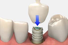 temporary restorations cement-retained crown using the Laser-Lok Easy Ti temp abutment and PEEK plastic sleeves 6 Prepare the shell crown Seat the appropriate polycarbonate/shell crown and modify as