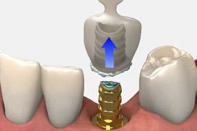 Note: Care must be taken to minimize the amount of reline material placed in the shell crown to prevent the acrylic/crown from locking onto the abutment base and to reduce the risk of acrylic