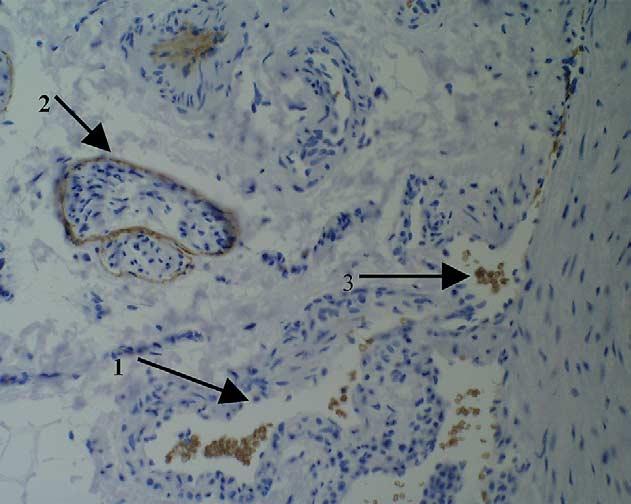 GLUT-1: an extra diagnostic tool to differentiate between haemangiomas and vascular malformations 351 Figure 4 samples. Negative controls All cases were negative for GLUT-1 expression.