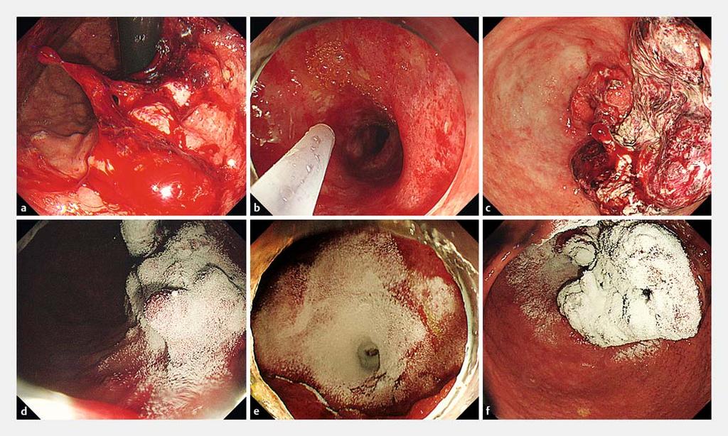 Fig.1 Selected cases representing use of EndoClot Polysaccharide Hemostatic System (PHS) for acute gastrointestinal bleeding in patients with a gastric malignancy. a, b, c Active tumor bleeding.