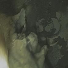 Angiodysplasia Neoplasms Post EMR Peptic ulcer bleed