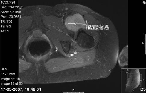 Fig. 1 MRI cut on the sagittal plane with a mass showing a similar signal, but not usually equal, to subcutaneous fat Discussion Hibernoma is an unusual benign soft tissue tumor derived from a