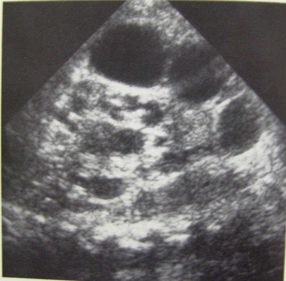 Multicystic-Dysplastic Kidney 2nd cause of neonatal abdominal