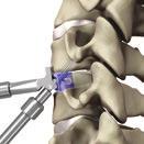 Optio-C Anterior Cervical Plate with Allograft/Autograft Surgical Technique Guide: Option 2 27 Lateral Screw Hole Preparation / Screw Placement Fig.
