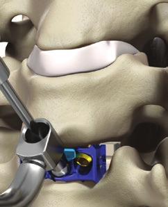Optio-C Anterior Cervical Plate with Allograft/Autograft Surgical Technique Guide: Option 2 33 Midline Screw Hole Preparation/ Screw Placement Fig. 72 Fig. 73 Fig.