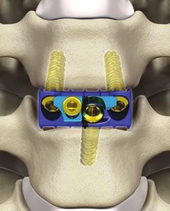 38 Optio-C Anterior Cervical Plate with Allograft/Autograft Surgical Technique Guide: Option 2 Fig. 85 Step 7 (continued) Turn the Driver clockwise.