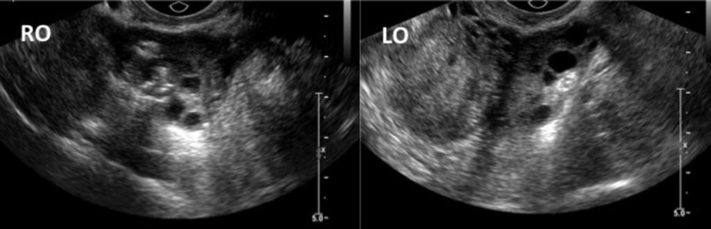 Fig. 2: Enlarged ovaries bilaterally with echogenic stroma and multiple peripherally sited small