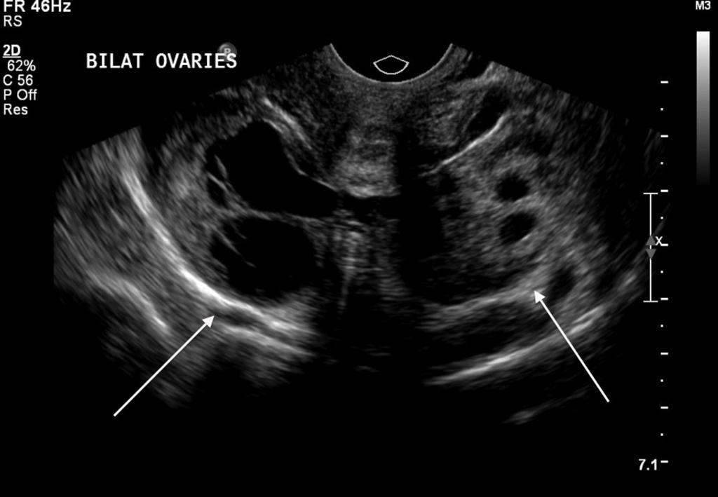 Fig. 4: US showing bilateral haemorrhagic cysts with the ovaries in close
