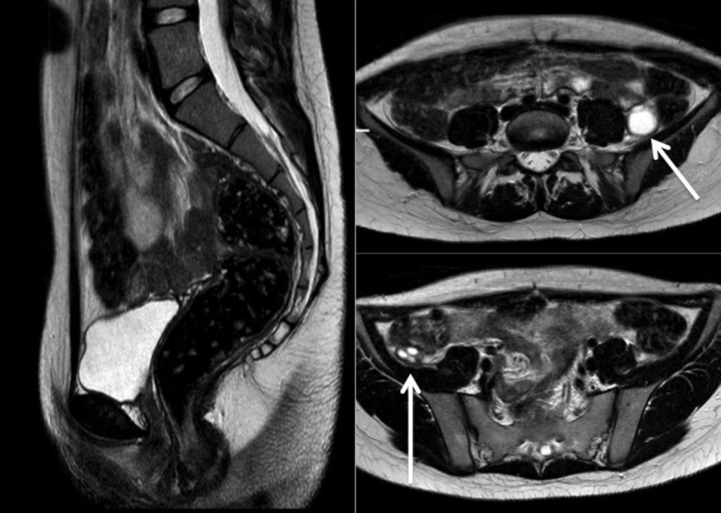 Fig. 11: Sagittal and axial T2 weighted MR images showing absence of the