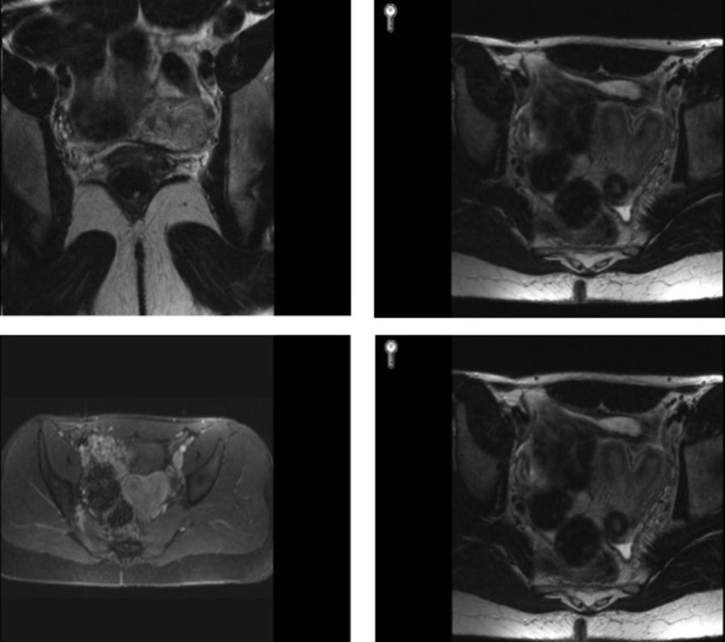 Fig. 16: MR appearances of separate uterus with separation of the uterine horns and increased