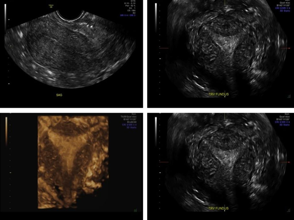 Fig. 17: US images of arcuate uterus showing a smooth fundal contour with mild