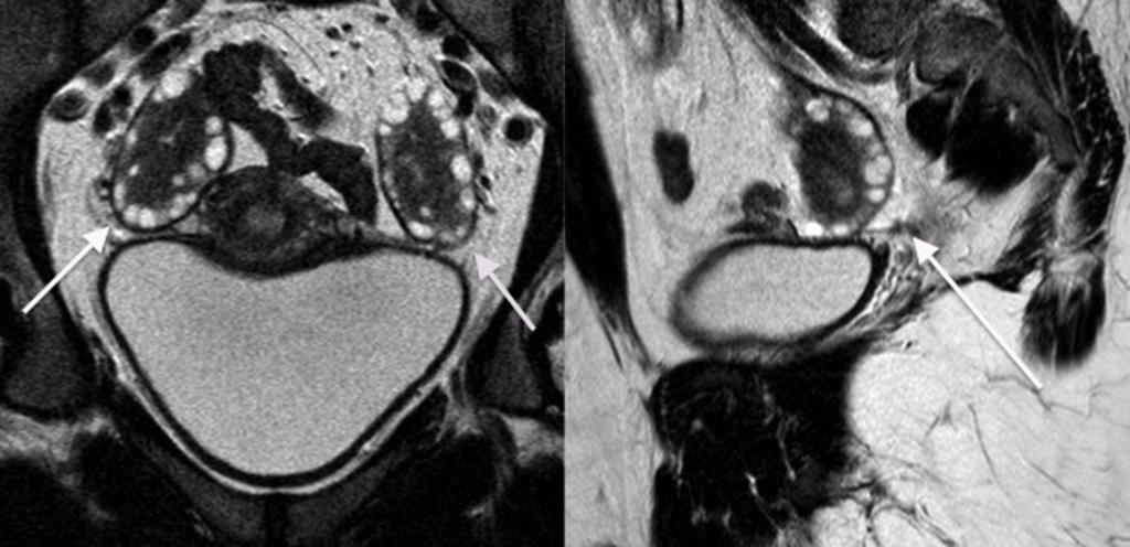 Fig. 19: Axial and sagittal T2 weighted MR images showing bilateral enlarged ovaries,