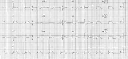 differentiate anterior wall ischemia from posterior STEMI Right