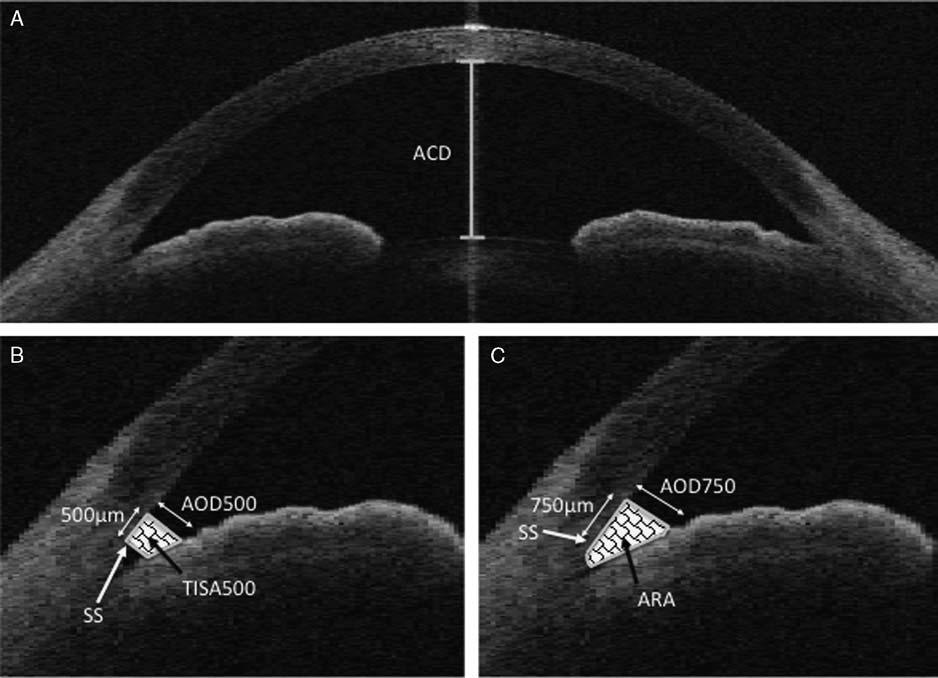 Siak et al J Glaucoma Volume 00, Number 00, 2015 nonindentational dark room gonioscopy) and raised IOP without glaucomatous optic neuropathy, or at least half clock-hour bands of peripheral anterior