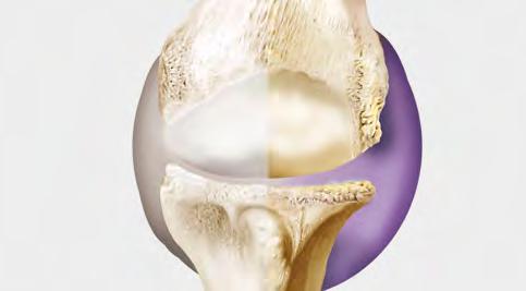 DUROLANE is the original single injection designed to relieve painful osteoarthritis (OA) in the knee or hip joint.