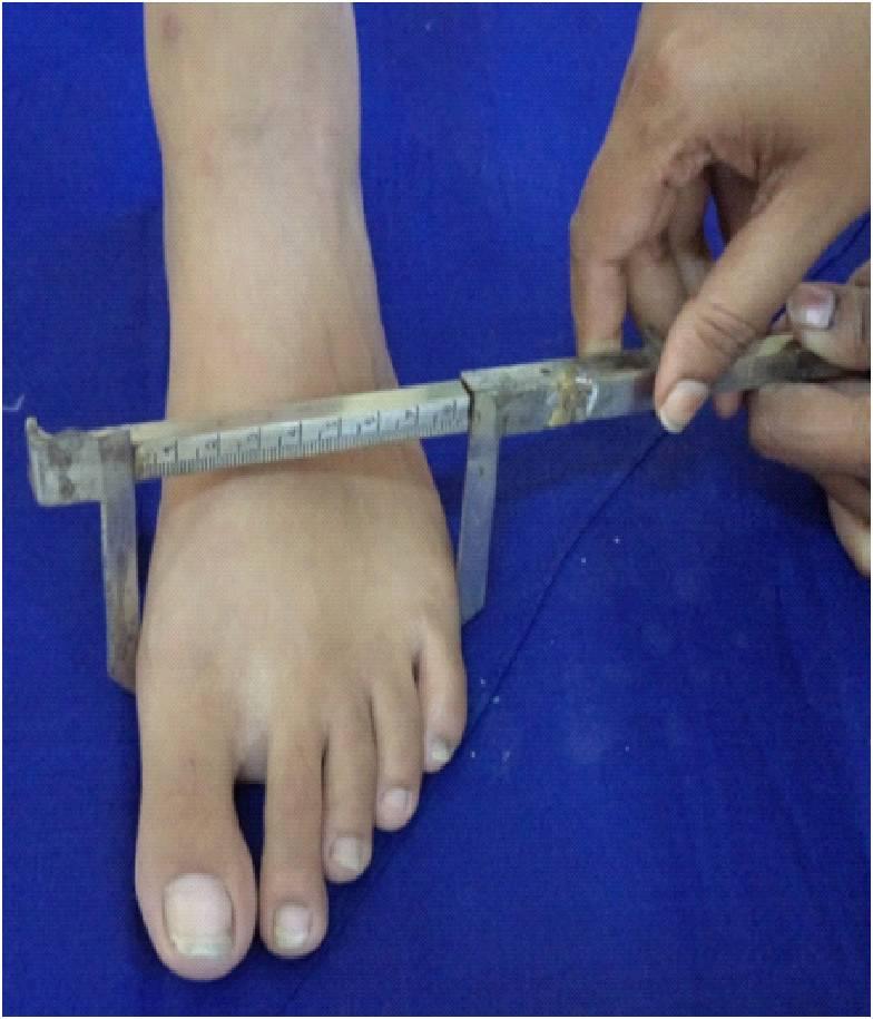 Ossification and maturation in the foot occur earlier in the long bones and therefore during adolescence age, stature could be more accurately predicted from foot measurements as compared to the