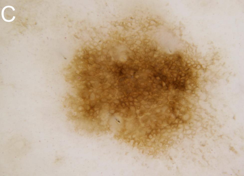 Histopathology is shown demonstrating melanoma