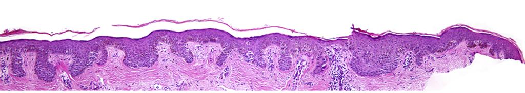 Dermatoscopic view. A: Histology slide 1.