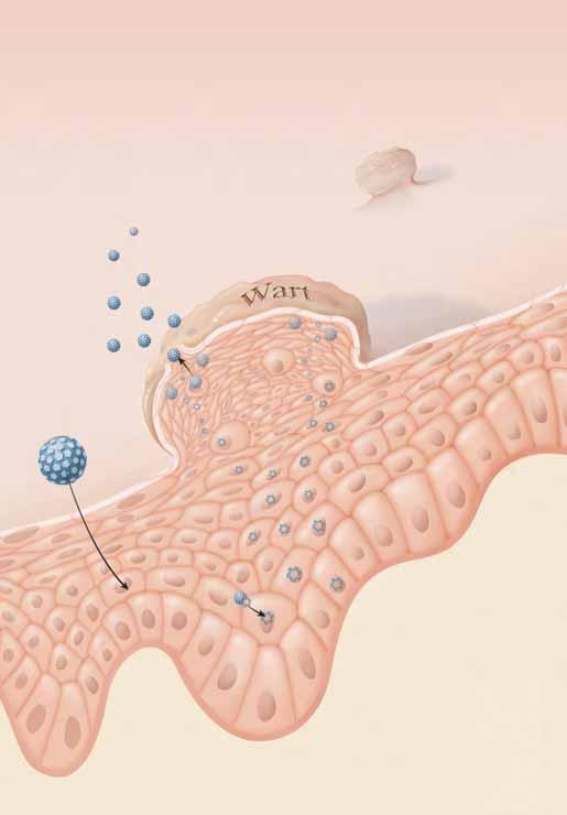 Understanding HPV Everyone with HPV has a different experience. Some people notice genital warts (condyloma) within a few months of exposure. In others, warts take years to appear or may never appear.