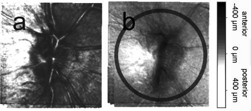 IOVS, December 2006, Vol. 47, No. 12 Evaluation of Glaucoma Probability Score 5351 FIGURE 2. Example of optic disc that could not be classified with the GPS.