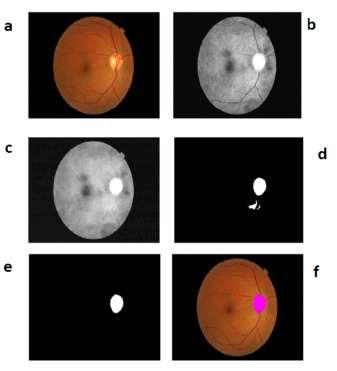 Figure 2: Set of multimodal photographs of eye analysed for optic disc detection a) Input Image b) Applying Adaptive Histogram Equalization c) After Closing Morphological Operation d) After Image