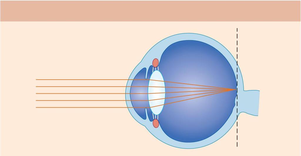 Focal length is fixed in the eye Emmetropic eye (normal)