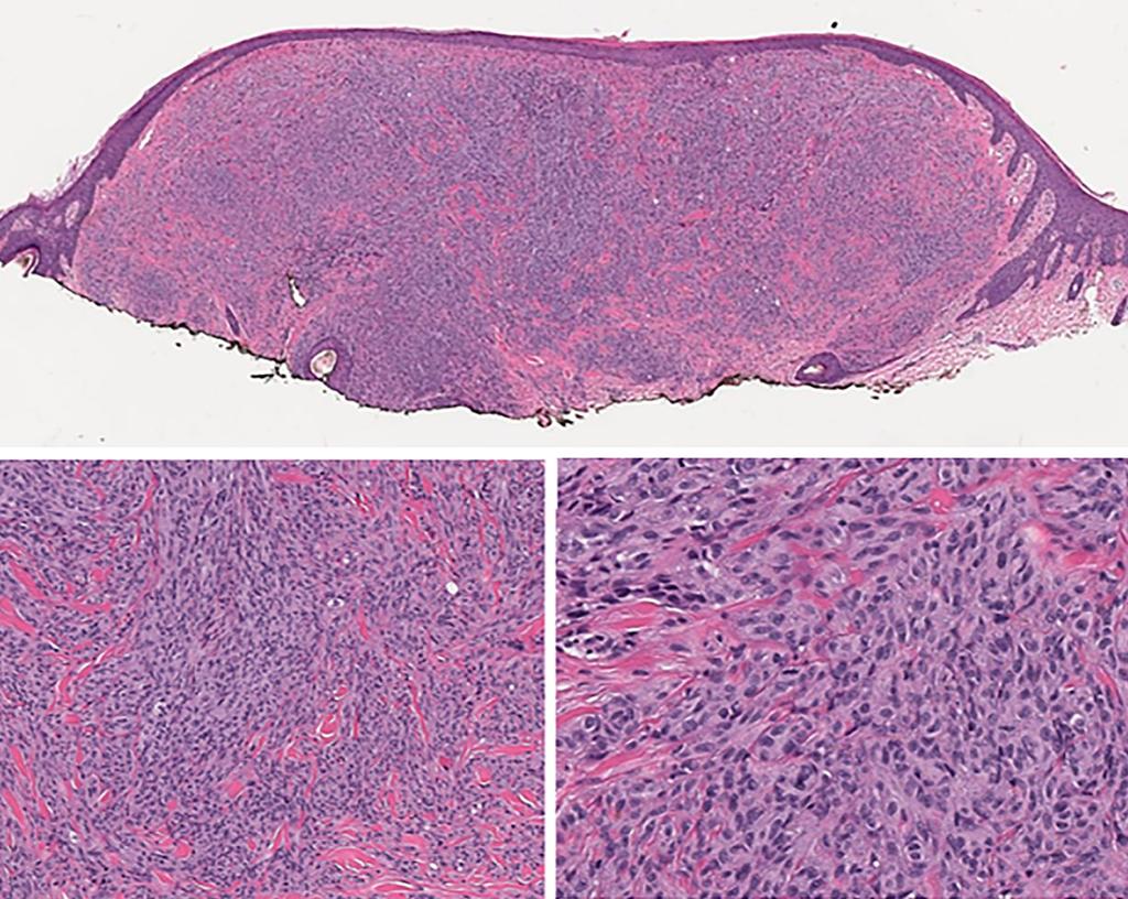 age 14 of 17 Dimonitsas et al. Molecular pathology of melanocytic tumors A B C Figure 7 Blue nevus-like melanoma. (A) A dermal melanocytic tumor consisting of spindle cells (H&E, 20).