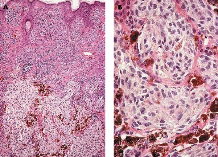 Melanoma arising in a naevus and naevoid melanoma Melanoma arising in a naevus differs from a clonal naevus in several ways.