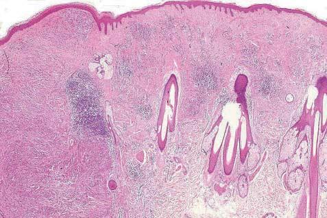 Melanomas efface the surrounding naevus, whereas the clonal lesion generally leaves the Figure 3 Melanoma (left side of field) arising in a congenital naevus from the scalp.