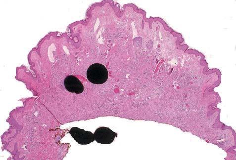 Other features that may be present include individual cell necrosis and atypical mitoses.