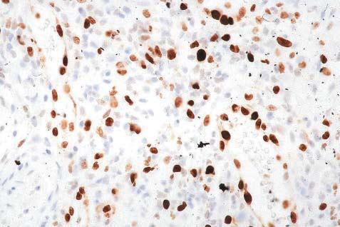 Excessive mitotic activity, deep mitoses, atypical mitoses, clear lack of maturation, and a pushing rather than infiltrative lower border should be viewed with particular concern (figs 8 and 9).