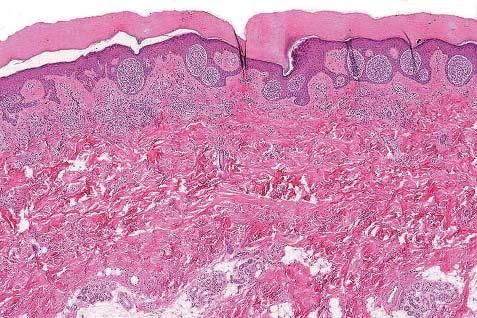The lentiginous architecture of dysplastic naevi is absent, as are lymphocytic infiltration, pigment incontinence, and dermal fibrosis.